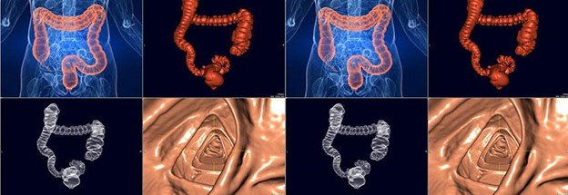  Can Colorectal Polyps and Cancer Be Found Early?